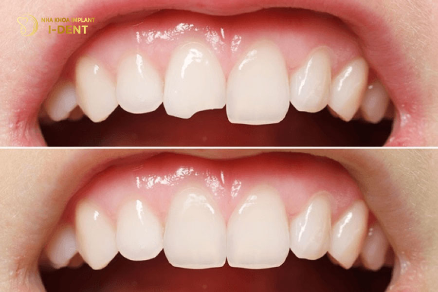 Trám composite thẩm mỹ